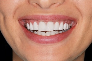 Close-up of healthy smile with no gum recession