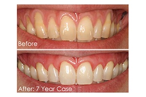 Smile before and after Chao pinhole surgery