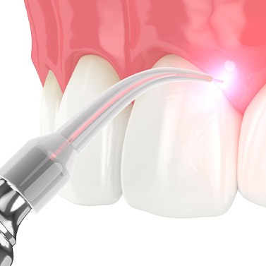 A CGI of laser periodontal treatment