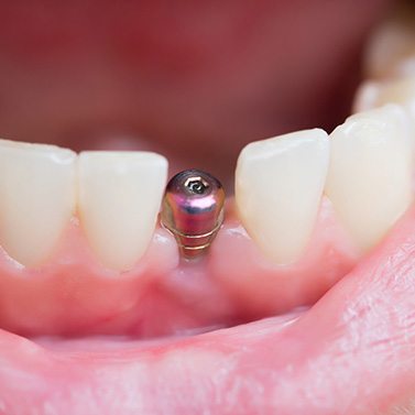 Closeup of dental implant in someone’s lower arch