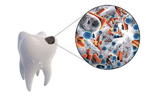 Illustration of cavity in tooth full of bacteria