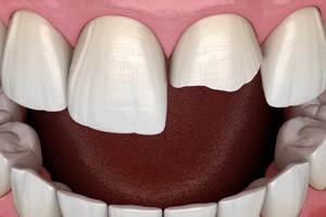Image of chipped tooth needing dental bonding