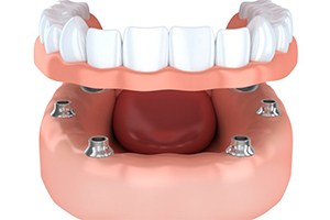 Animation of implant crowns