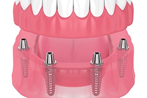 Illustration of dental implants and denture in Lakewood, CO