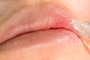 a person receiving a dermal filler injection into their lip