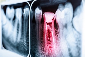 X-ray of tooth needing tooth extractions in Lakewood