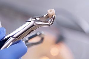 dentist holding extracted tooth with forceps 