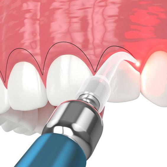Illustration of gum recontouring process