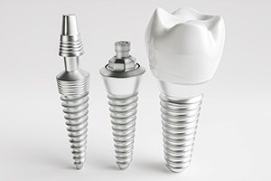 Diagram highlighting components of dental implants in Lakewood