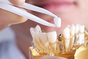 Lakewood implant dentist placing final restoration on model