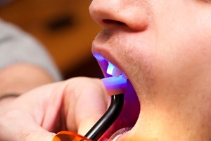 curing light being used to harden fillings