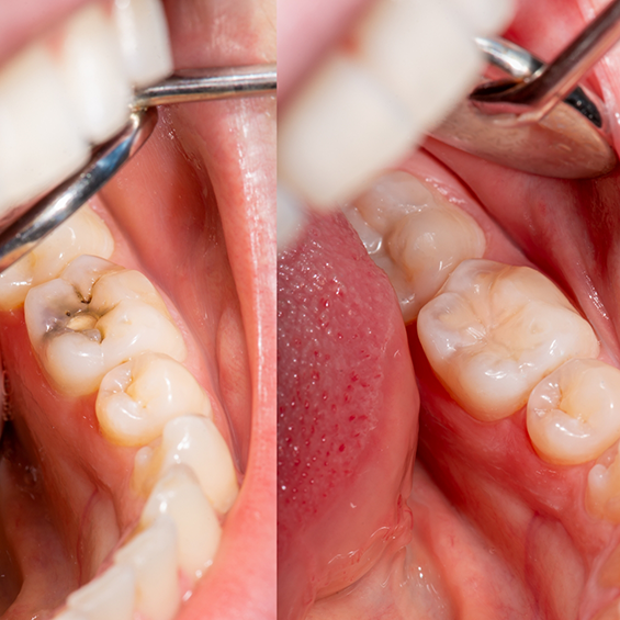 Close up of a decayed toth before and after receiving a tooth colored filling in Lakewood