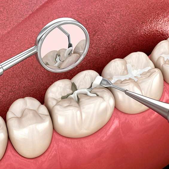 Illustration of a white filling being placed in a tooth