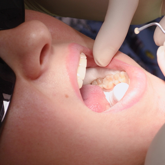 Dentist placing a white filling in a tooth