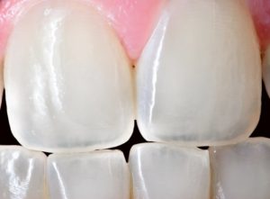 black gaps between teeth