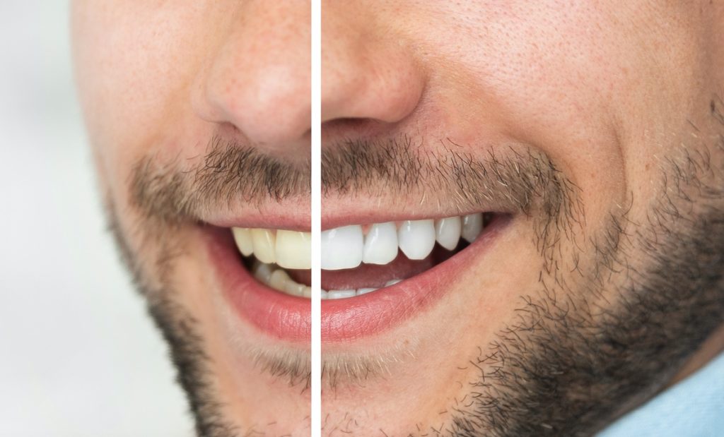 Man before and after teeth whitening treatment from dentist in 