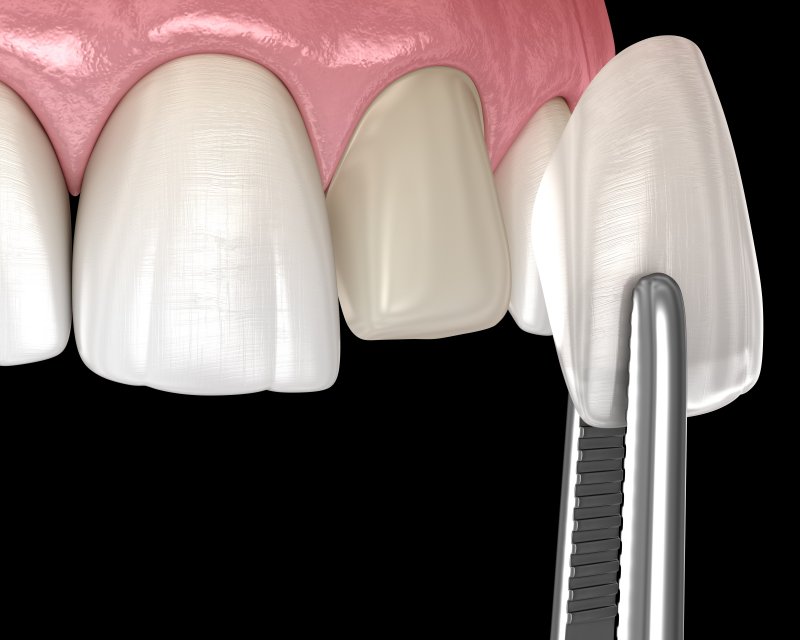 3D illustration of veneer being placed