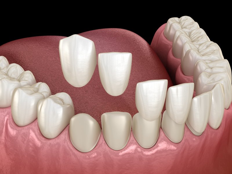 3-D Diagram of veneers plastered on a smile