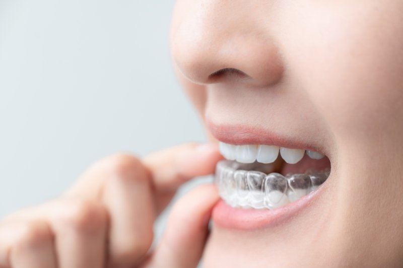 Patient taking off their aligner to get their Invisalign attachments removed.