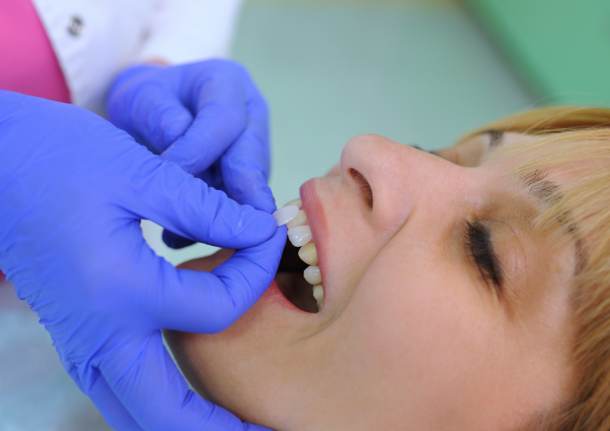 Woman getting veneers