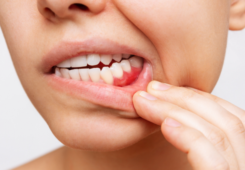 Woman with inflammed gums